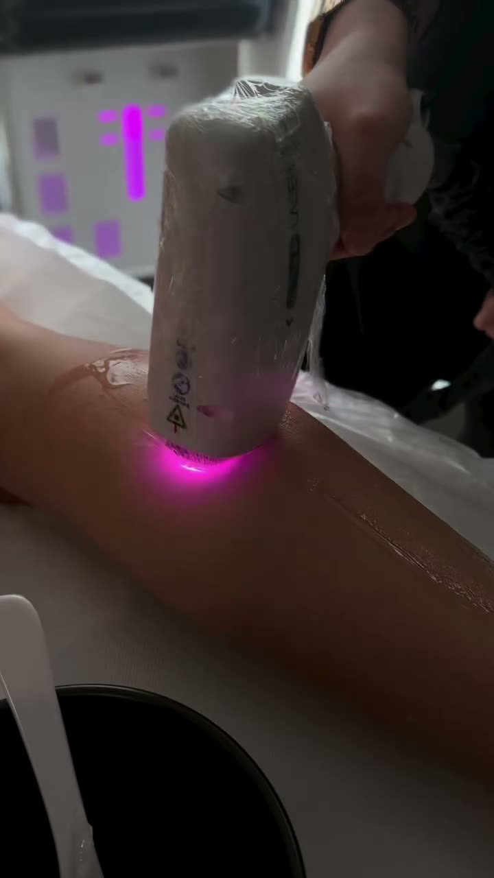 Depilazione con laser a diodo Beautech